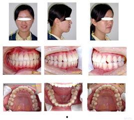 成人磨牙能拔掉吗视频